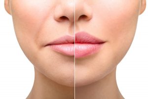 Juvederm Injectable Gels for Lips