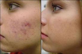 Photofacial for Acne Scars on Woman Before After
