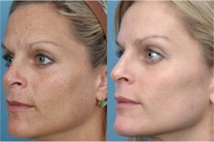 Photofacial for Sun Damage on Woman Before After