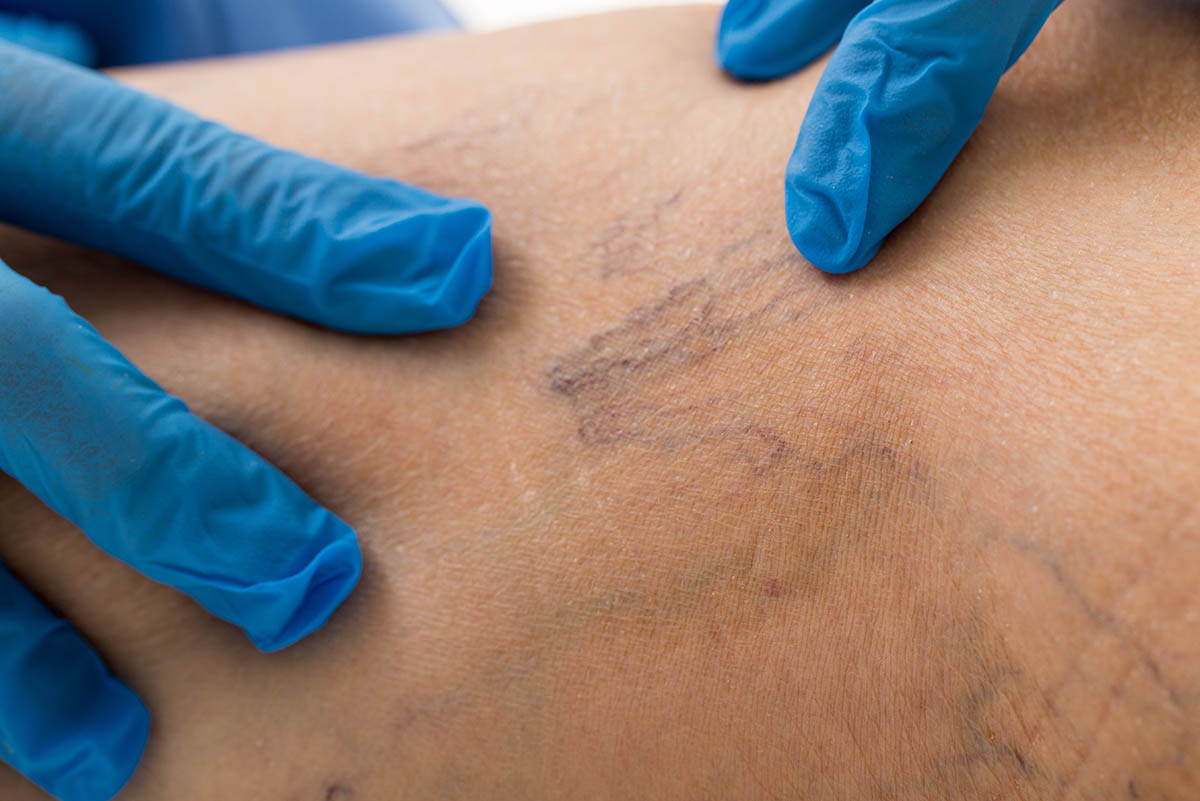 Sclerotherapy Spider Vein Treatment