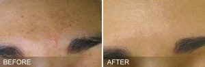 Hydrafacial for Brown Spots Before After