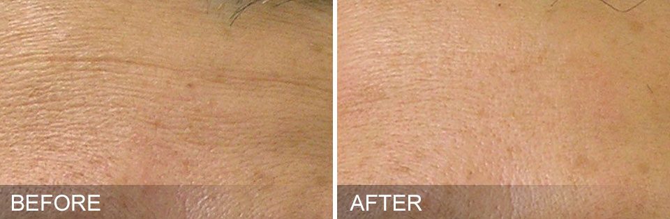 Hydrafacial for Fine Lines Before After