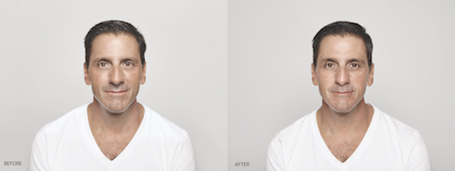 Restylane on Man Before After