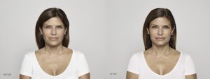 Restylane on Woman Before After