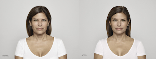 Restylane on Woman Before After