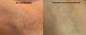 MiraSmooth Before After 12 months