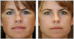 Photofacial Before After
