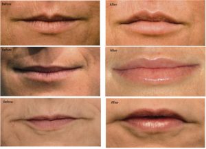 Juvederm for Lips Before After