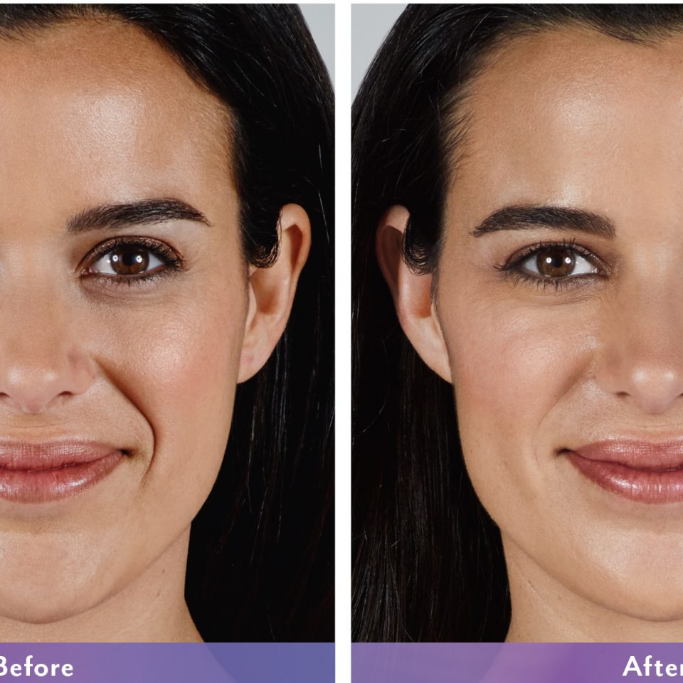 Juvederm Vollure Before After