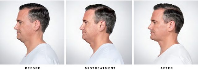 Kybella on Man Before Midtreatment After