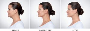 Kybella on Woman Before Midtreatment After