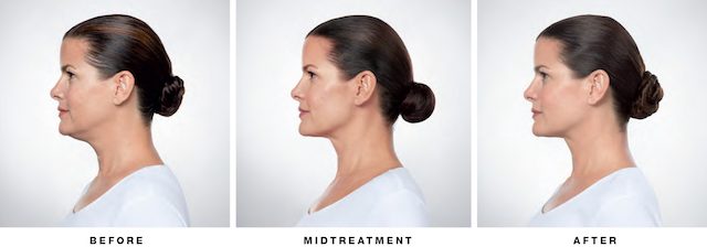 Kybella on Woman Before Midtreatment After