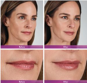 Voluma on Lips Before After