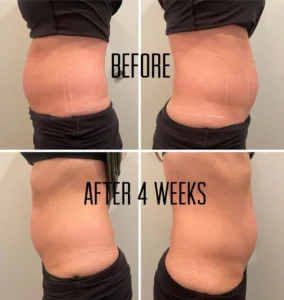 BBody Sculpt Before and After